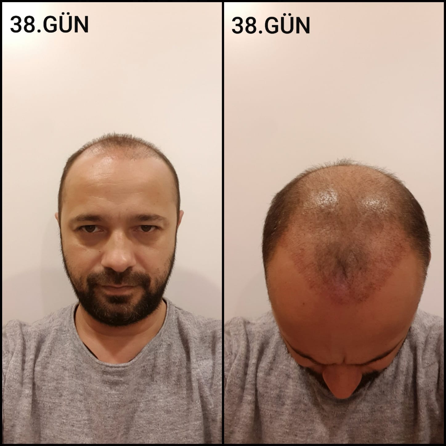Заживление после пересадки волос день 38 – средняя фаза заживления с шоковым выпадением и дальнейшим процессом заживления