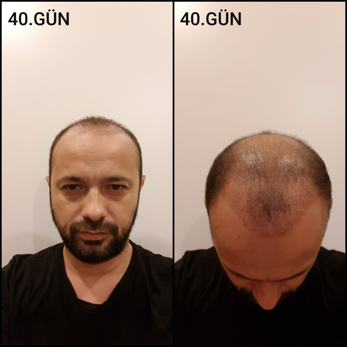 Заживление после пересадки волос день 40 – средняя фаза заживления с шоковым выпадением и дальнейшим процессом заживления