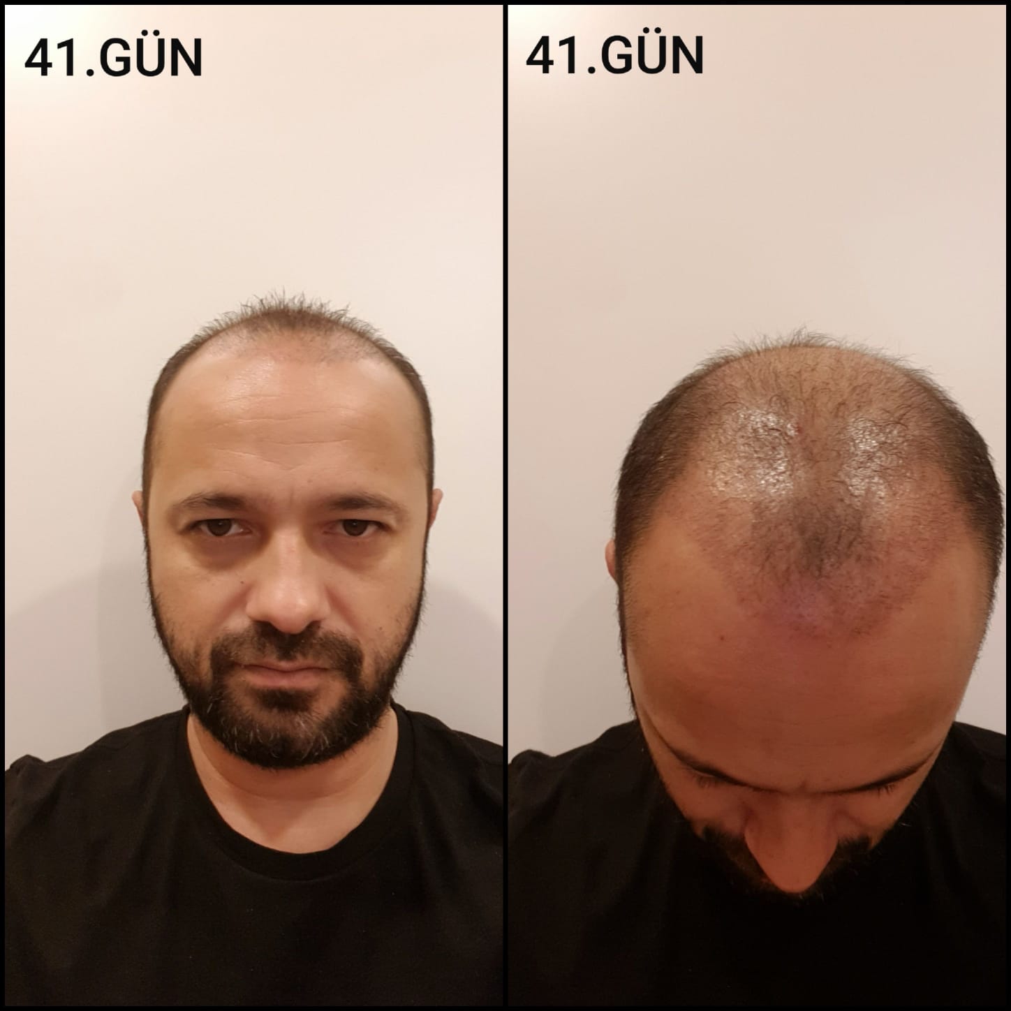 Заживление после пересадки волос день 41 – средняя фаза заживления с шоковым выпадением и дальнейшим процессом заживления