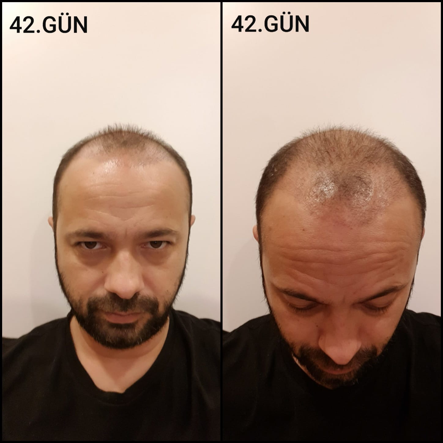 Заживление после пересадки волос день 42 – средняя фаза заживления с шоковым выпадением и дальнейшим процессом заживления