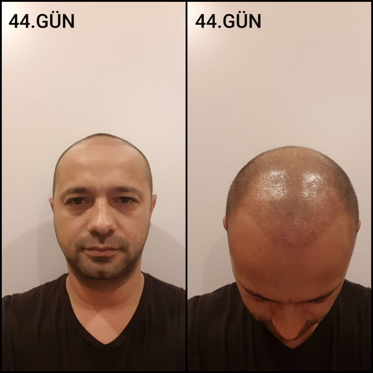 Заживление после пересадки волос день 44 – средняя фаза заживления с шоковым выпадением и дальнейшим процессом заживления