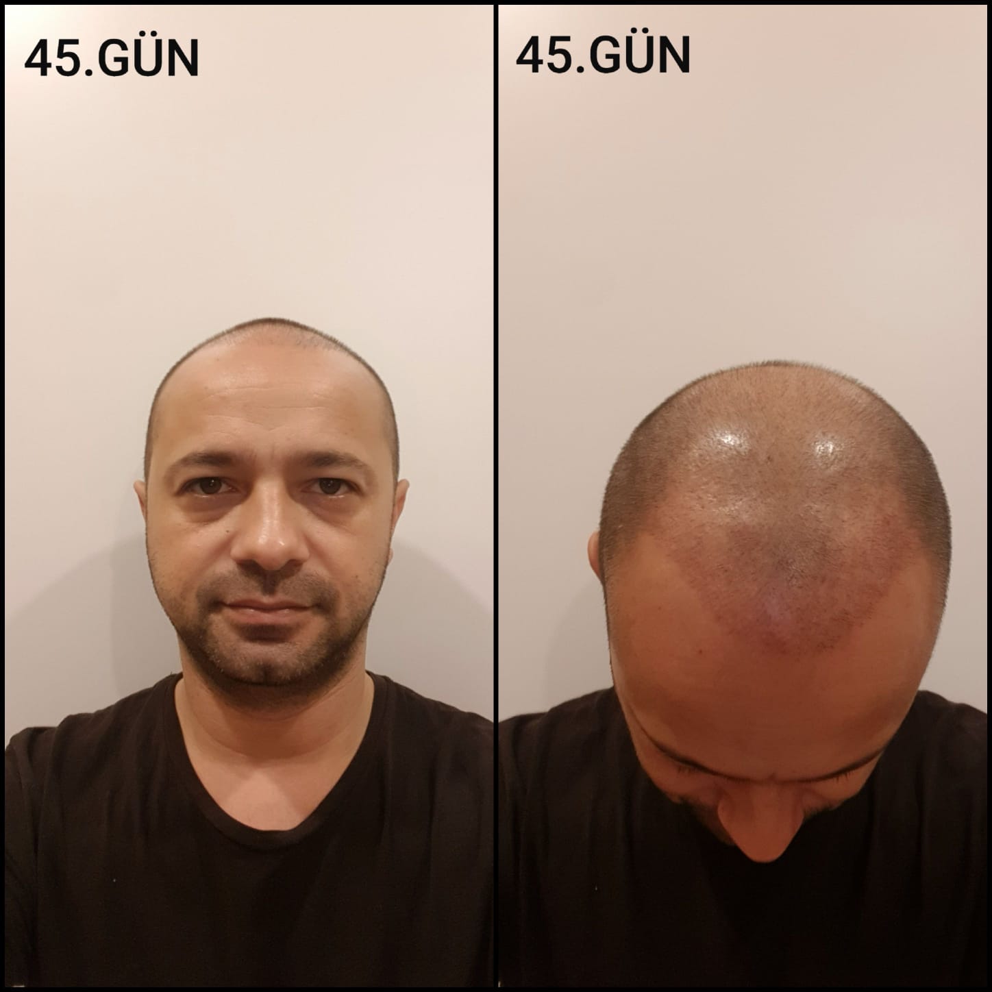 Заживление после пересадки волос день 45 – средняя фаза заживления с шоковым выпадением и дальнейшим процессом заживления