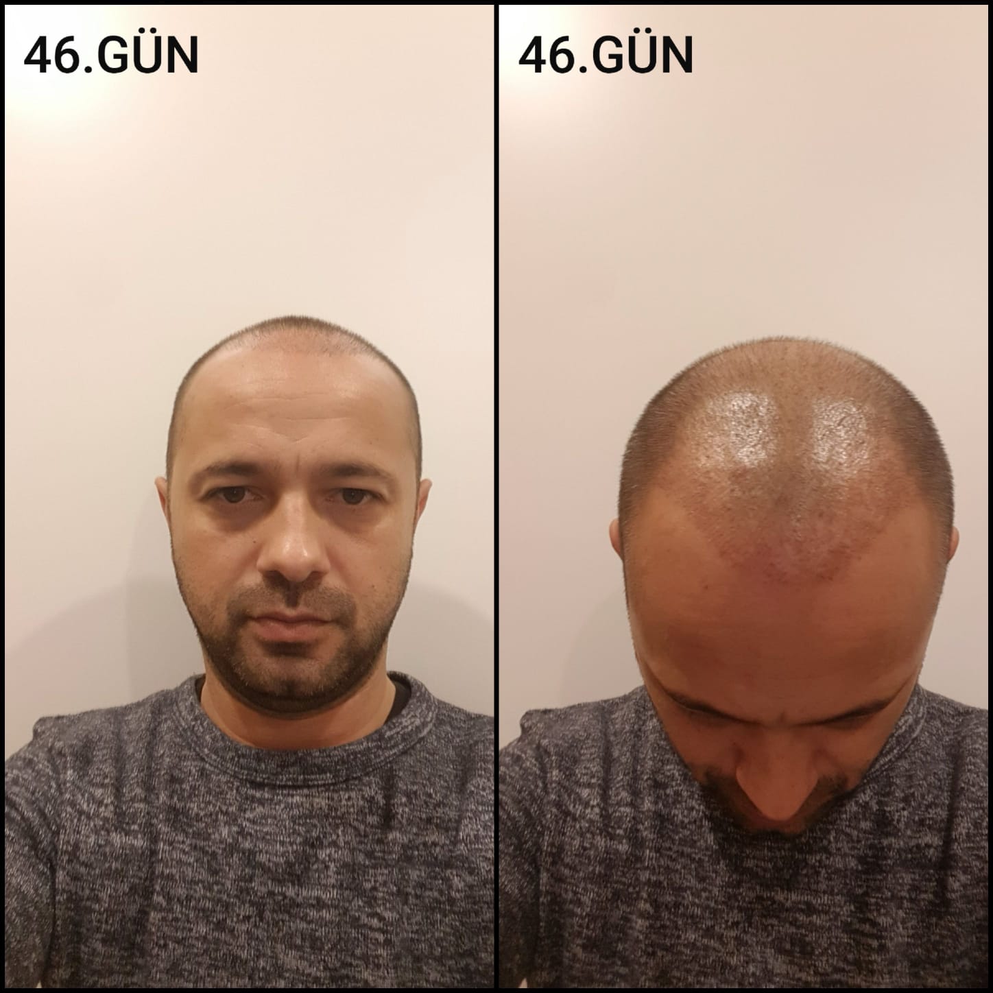 Заживление после пересадки волос день 46 – средняя фаза заживления с шоковым выпадением и дальнейшим процессом заживления