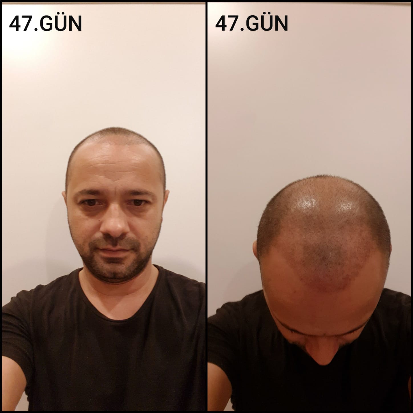 Заживление после пересадки волос день 47 – средняя фаза заживления с шоковым выпадением и дальнейшим процессом заживления