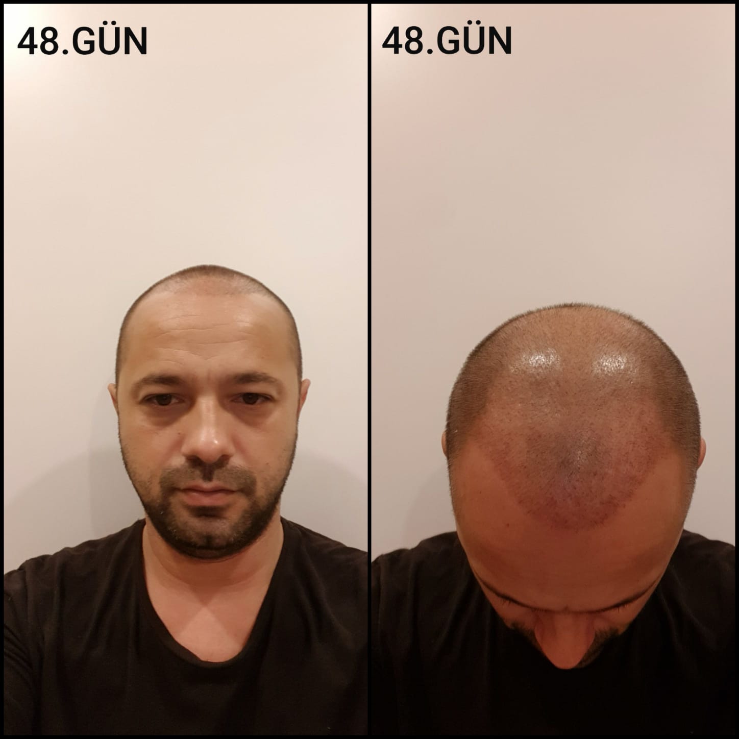 Заживление после пересадки волос день 48 – средняя фаза заживления с шоковым выпадением и дальнейшим процессом заживления
