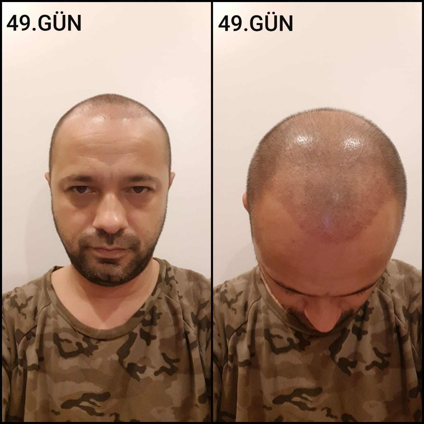 Заживление после пересадки волос день 49 – средняя фаза заживления с шоковым выпадением и дальнейшим процессом заживления
