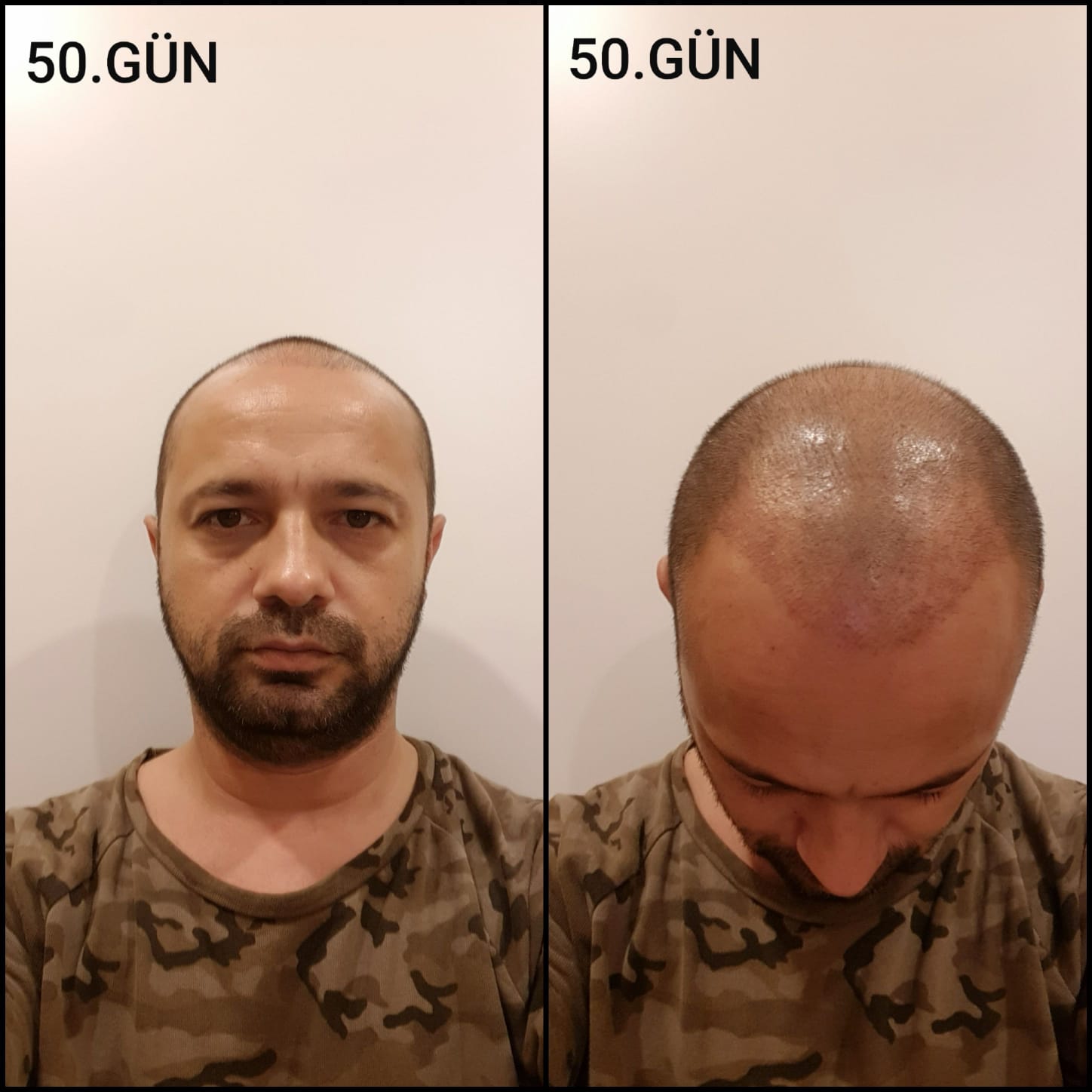 Заживление после пересадки волос день 50 – средняя фаза заживления с шоковым выпадением и дальнейшим процессом заживления