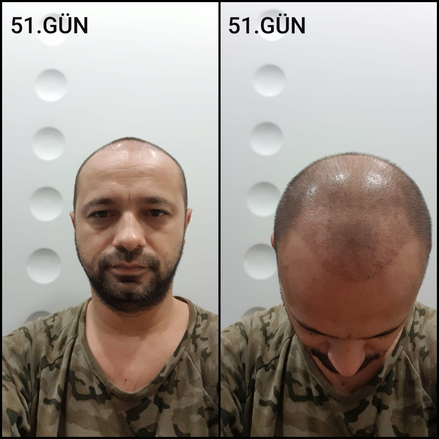 Заживление после пересадки волос день 51 – средняя фаза заживления с шоковым выпадением и дальнейшим процессом заживления