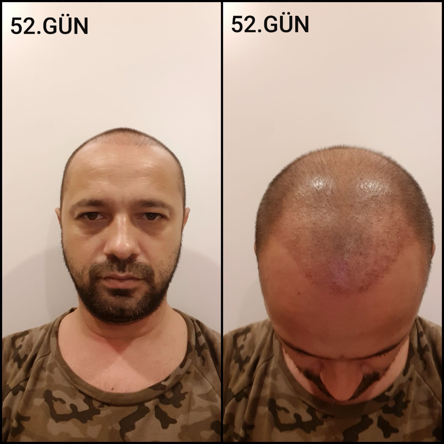 Заживление после пересадки волос день 52 – средняя фаза заживления с шоковым выпадением и дальнейшим процессом заживления