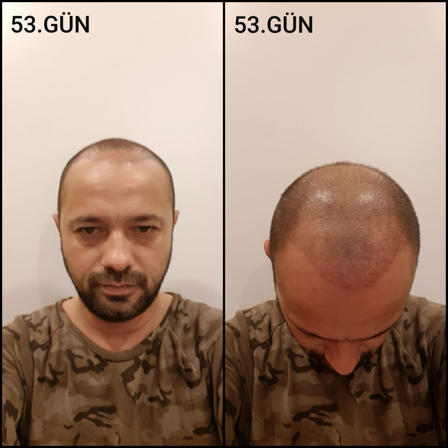 Заживление после пересадки волос день 53 – средняя фаза заживления с шоковым выпадением и дальнейшим процессом заживления