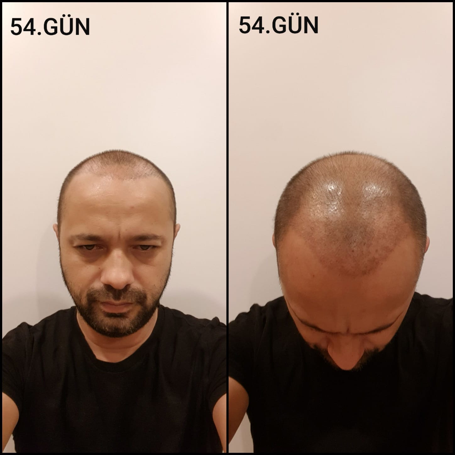 Заживление после пересадки волос день 54 – средняя фаза заживления с шоковым выпадением и дальнейшим процессом заживления