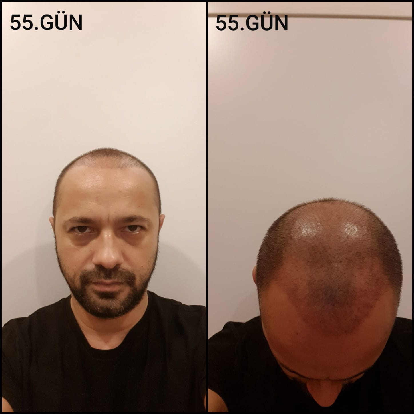 Заживление после пересадки волос день 55 – средняя фаза заживления с шоковым выпадением и дальнейшим процессом заживления