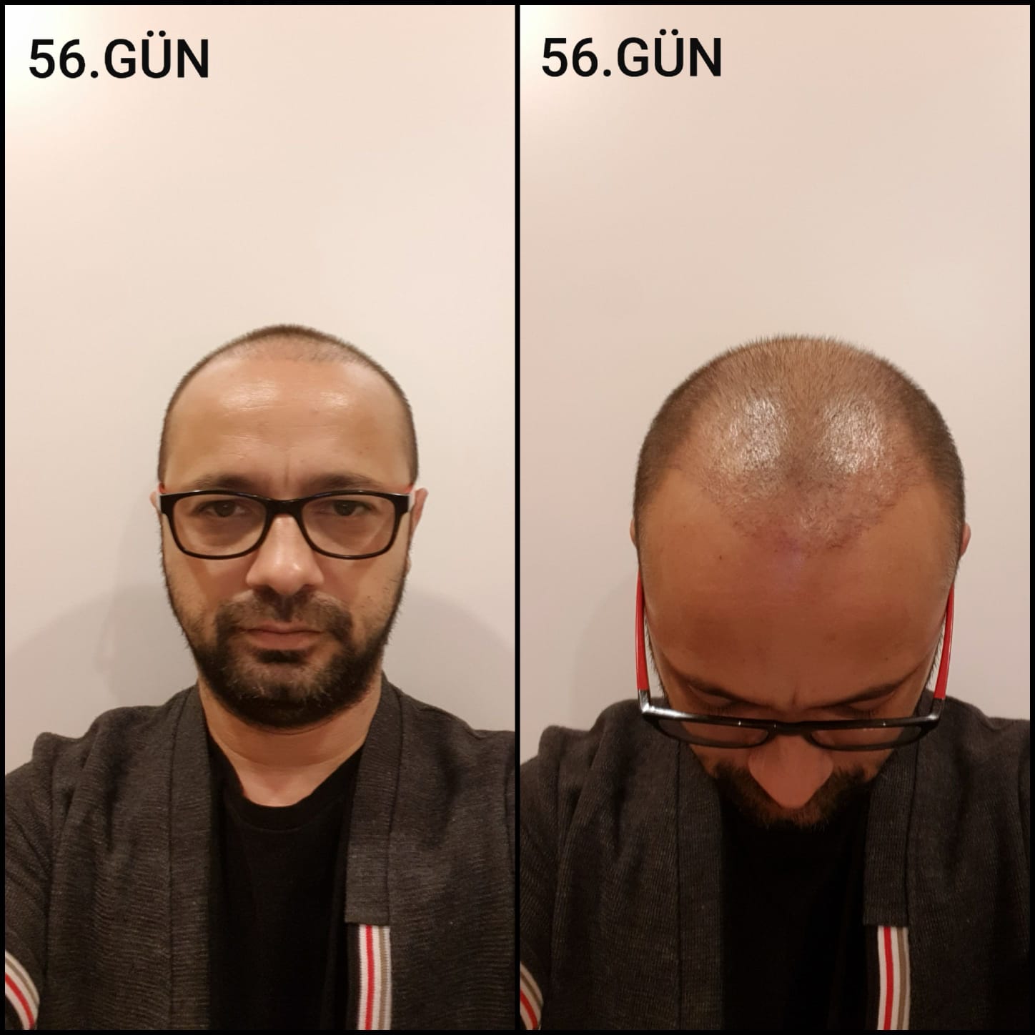 Заживление после пересадки волос день 56 – средняя фаза заживления с шоковым выпадением и дальнейшим процессом заживления