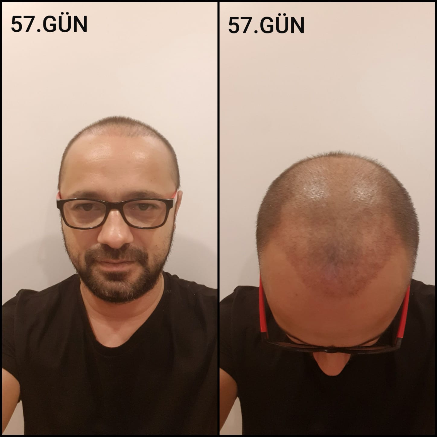 Заживление после пересадки волос день 57 – средняя фаза заживления с шоковым выпадением и дальнейшим процессом заживления