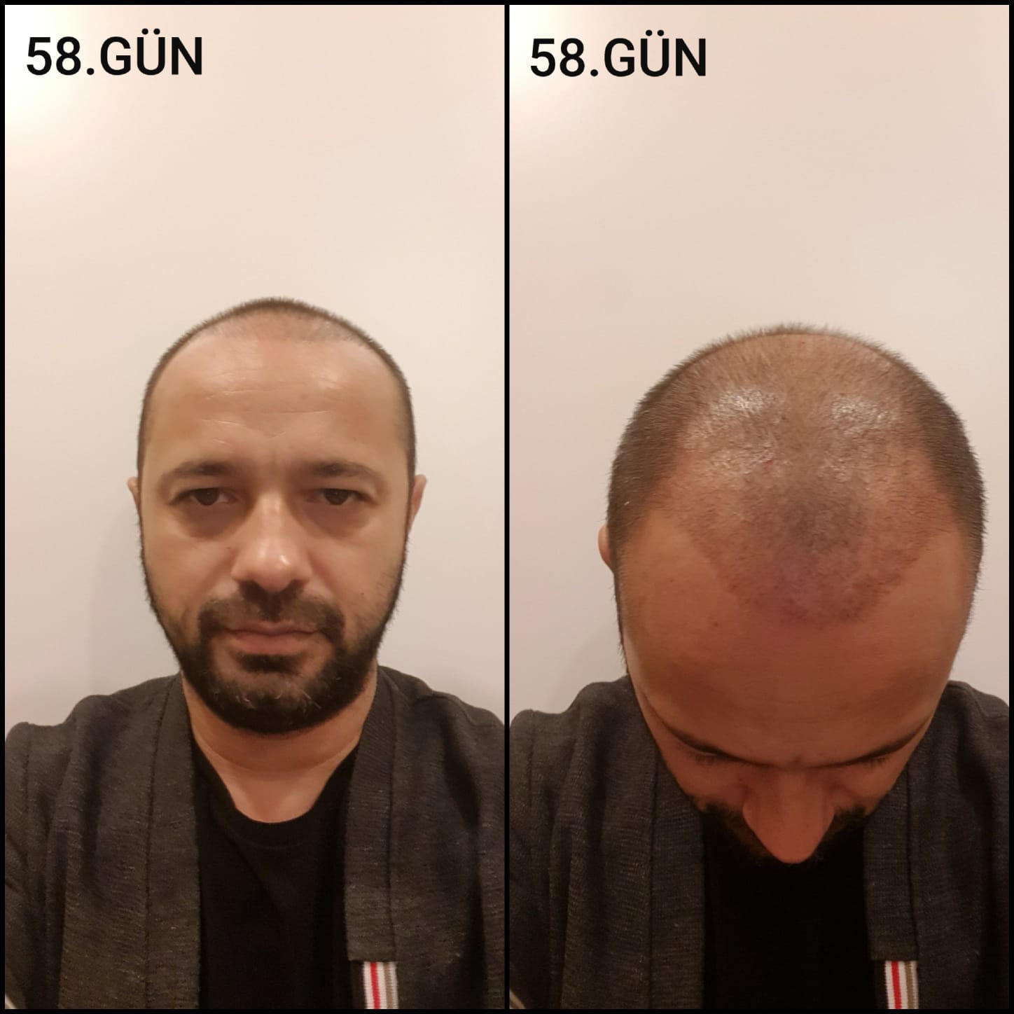 Заживление после пересадки волос день 58 – средняя фаза заживления с шоковым выпадением и дальнейшим процессом заживления