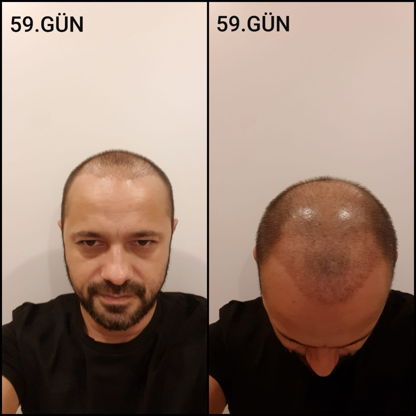 Заживление после пересадки волос день 59 – средняя фаза заживления с шоковым выпадением и дальнейшим процессом заживления