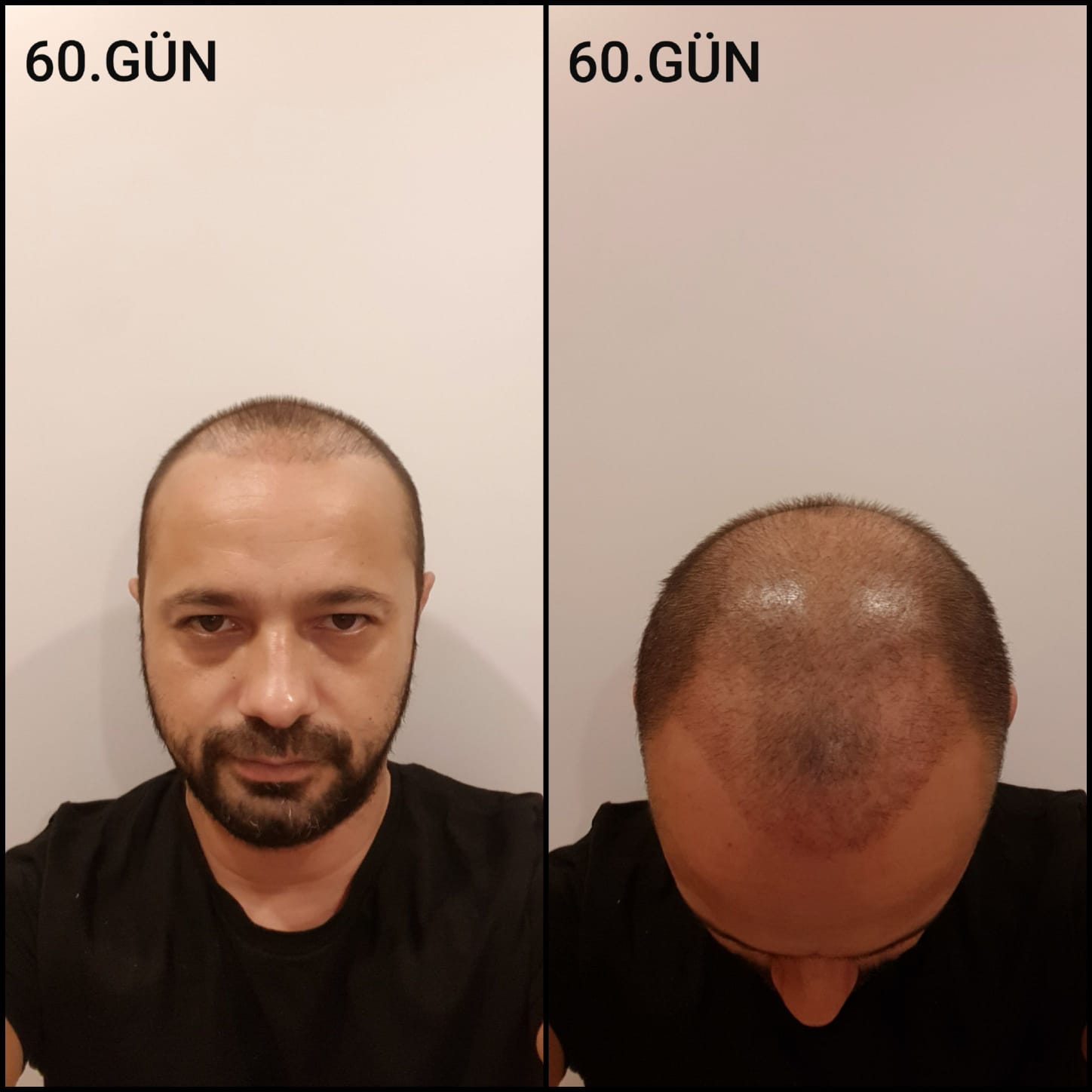 Заживление после пересадки волос день 60 – средняя фаза заживления с шоковым выпадением и дальнейшим процессом заживления