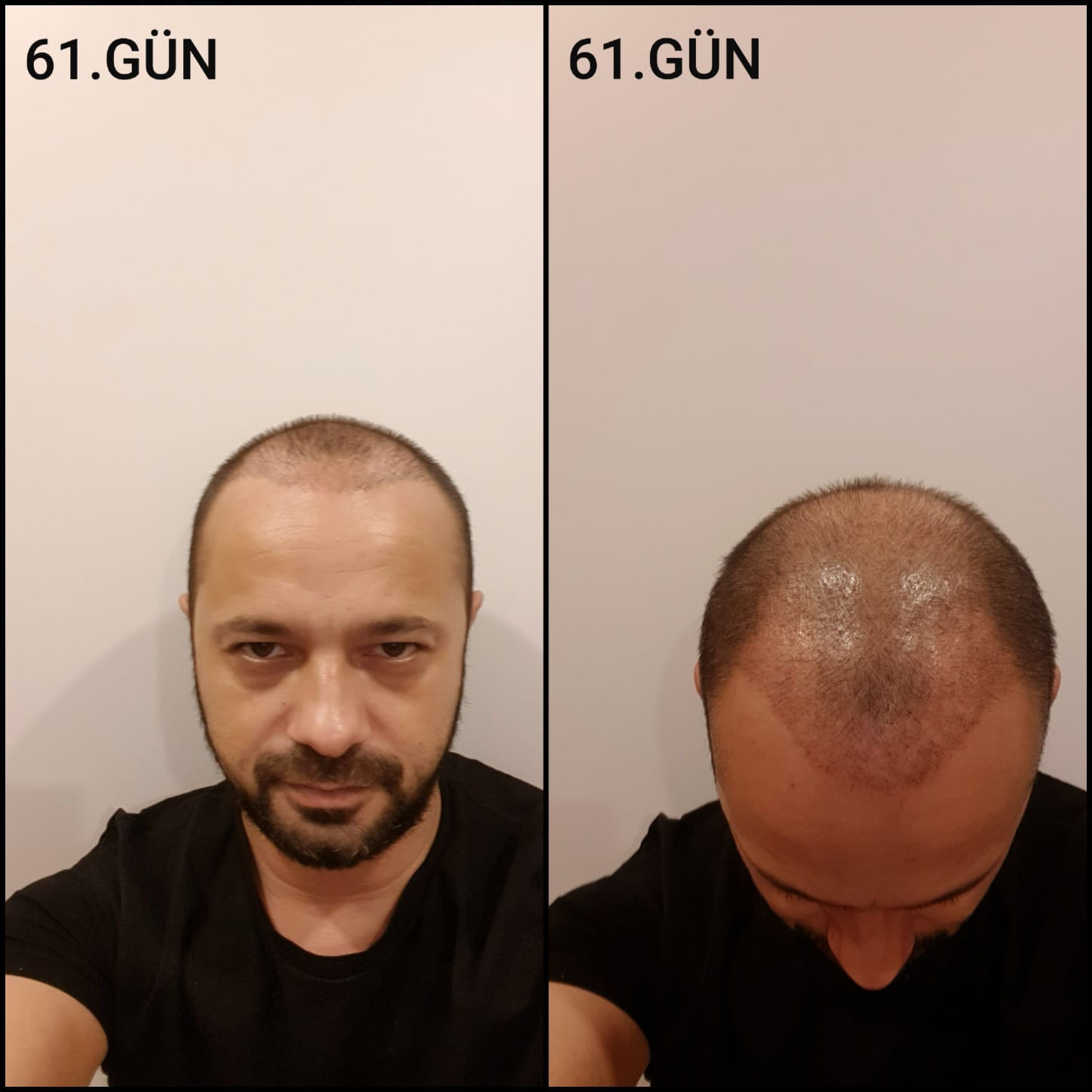 Заживление после пересадки волос день 61 – средняя фаза заживления с шоковым выпадением и дальнейшим процессом заживления