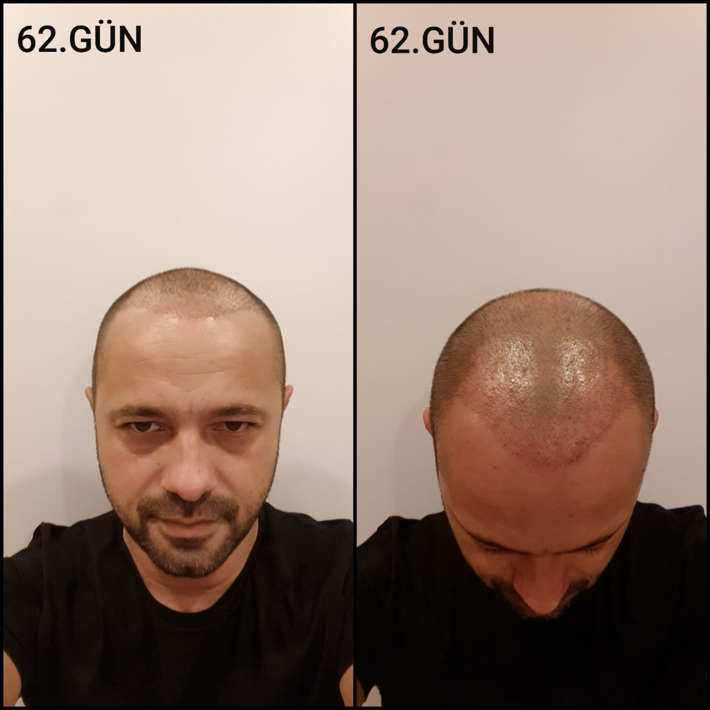 Заживление после пересадки волос день 62 – средняя фаза заживления с шоковым выпадением и дальнейшим процессом заживления
