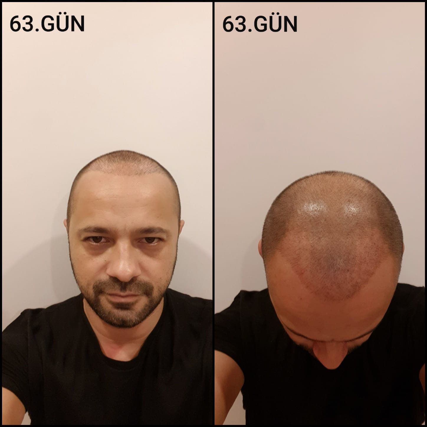 Заживление после пересадки волос день 63 – средняя фаза заживления с шоковым выпадением и дальнейшим процессом заживления