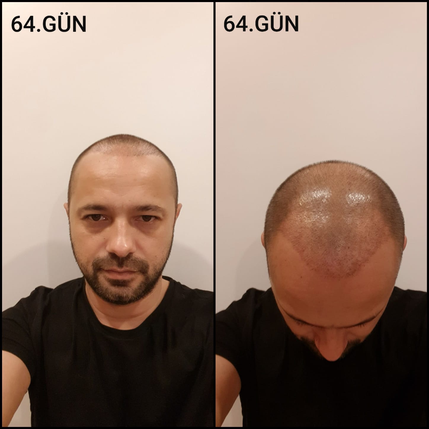 Заживление после пересадки волос день 64 – средняя фаза заживления с шоковым выпадением и дальнейшим процессом заживления