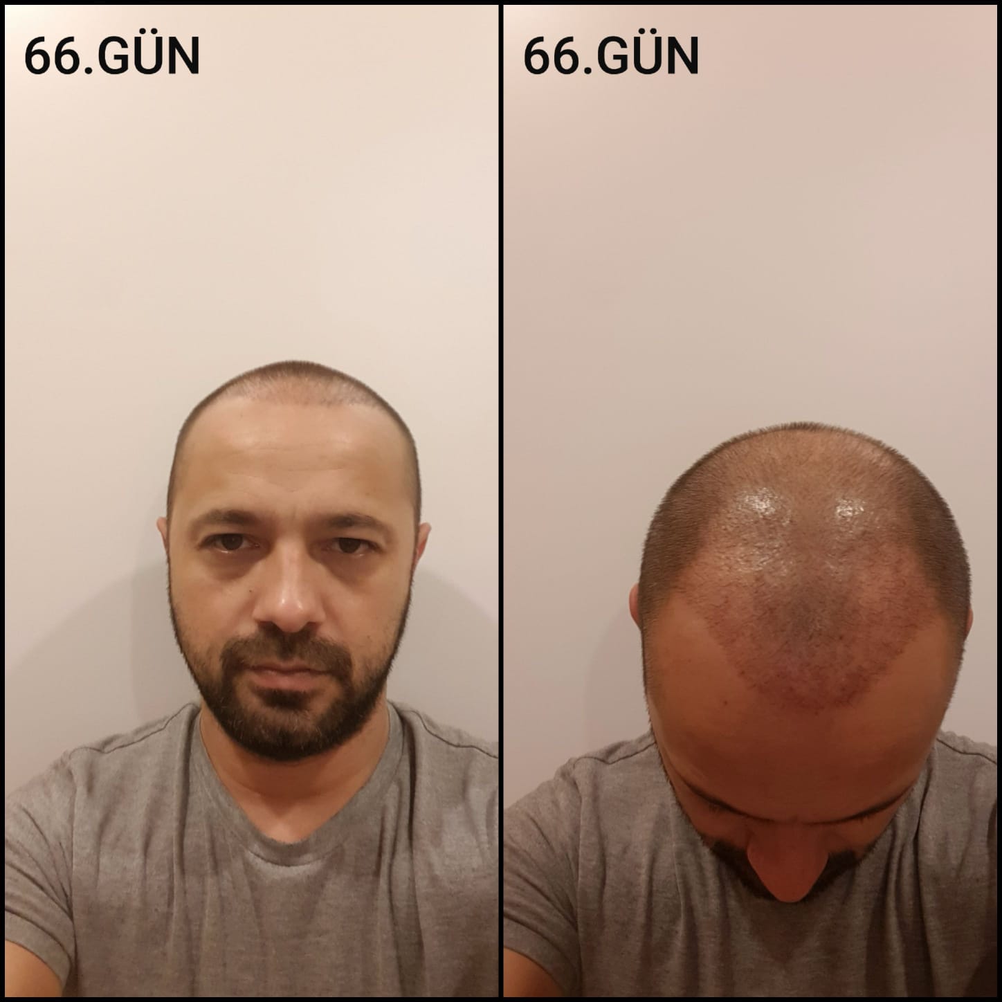 Заживление после пересадки волос день 66 – средняя фаза заживления с шоковым выпадением и дальнейшим процессом заживления