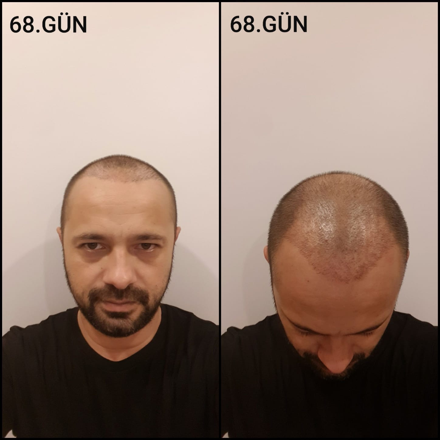 Заживление после пересадки волос день 68 – средняя фаза заживления с шоковым выпадением и дальнейшим процессом заживления