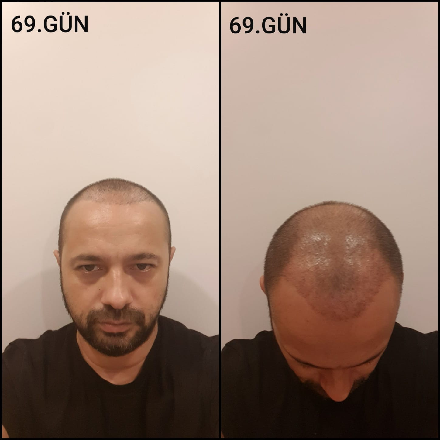 Заживление после пересадки волос день 69 – средняя фаза заживления с шоковым выпадением и дальнейшим процессом заживления