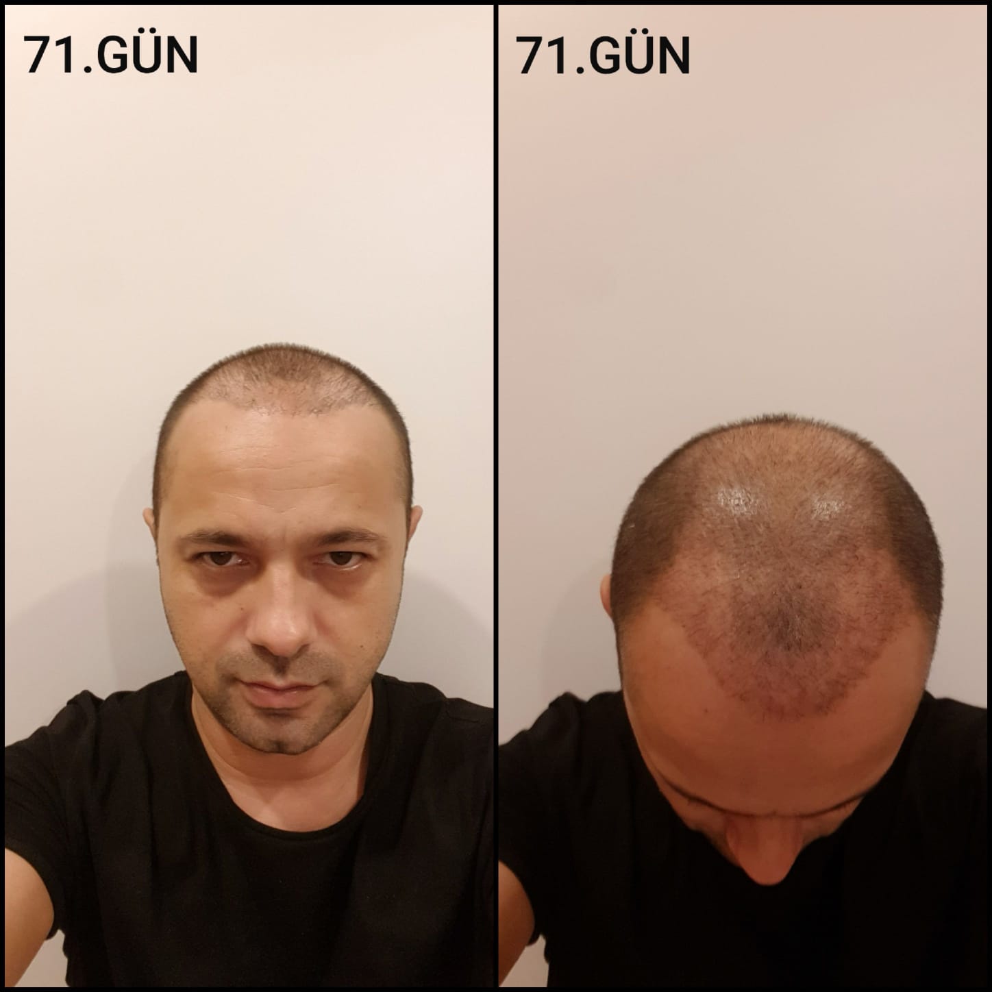 Заживление после пересадки волос день 71 – средняя фаза заживления с шоковым выпадением и дальнейшим процессом заживления