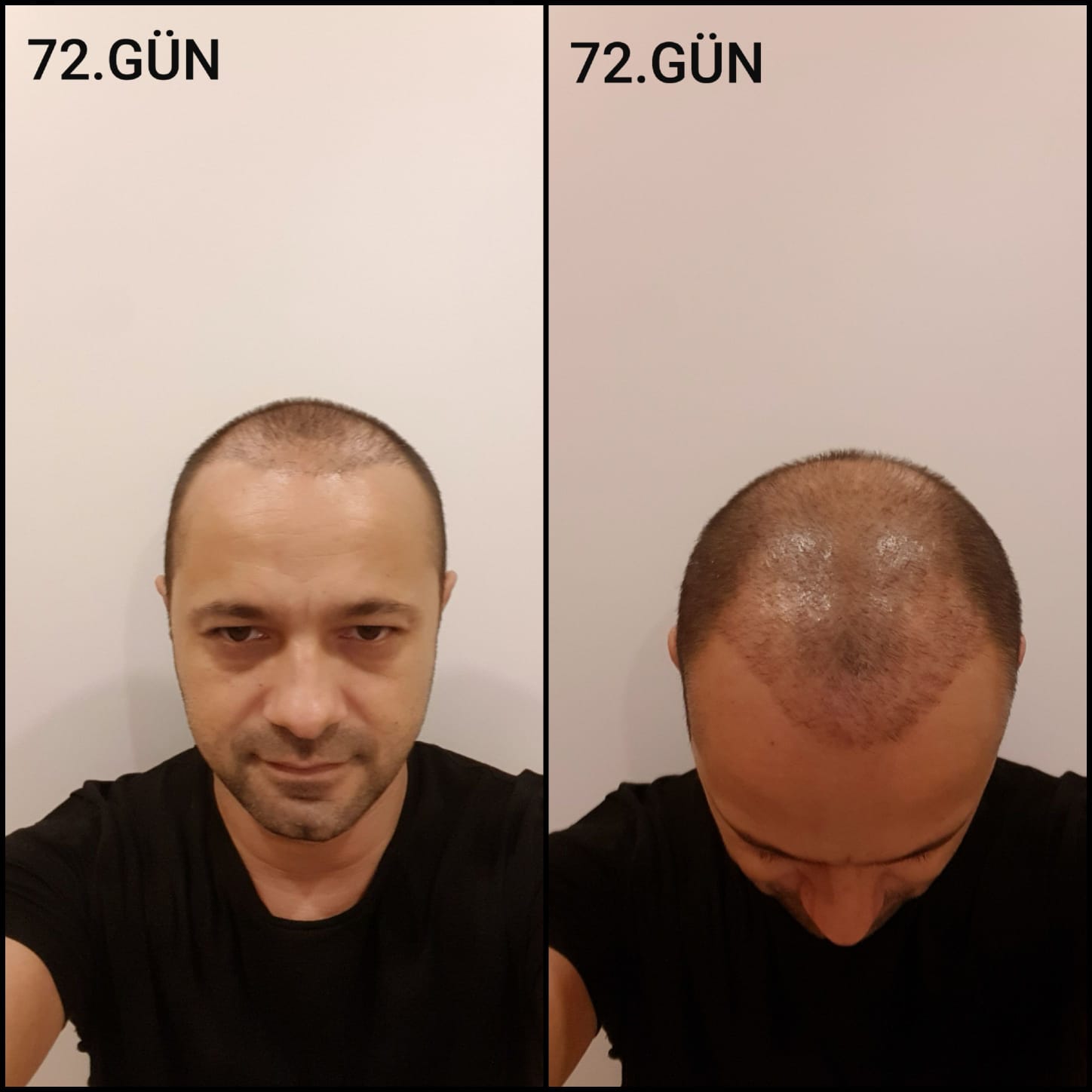 Заживление после пересадки волос день 72 – средняя фаза заживления с шоковым выпадением и дальнейшим процессом заживления