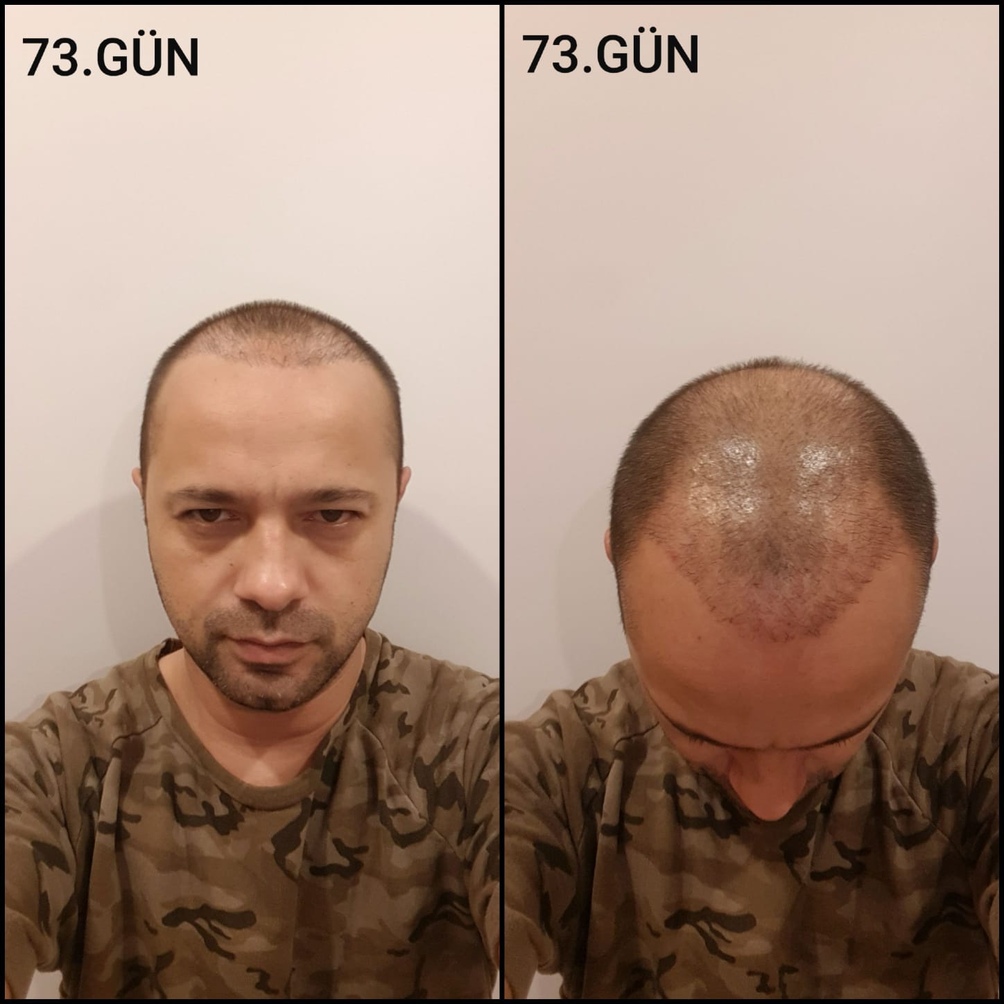 Заживление после пересадки волос день 73 – средняя фаза заживления с шоковым выпадением и дальнейшим процессом заживления