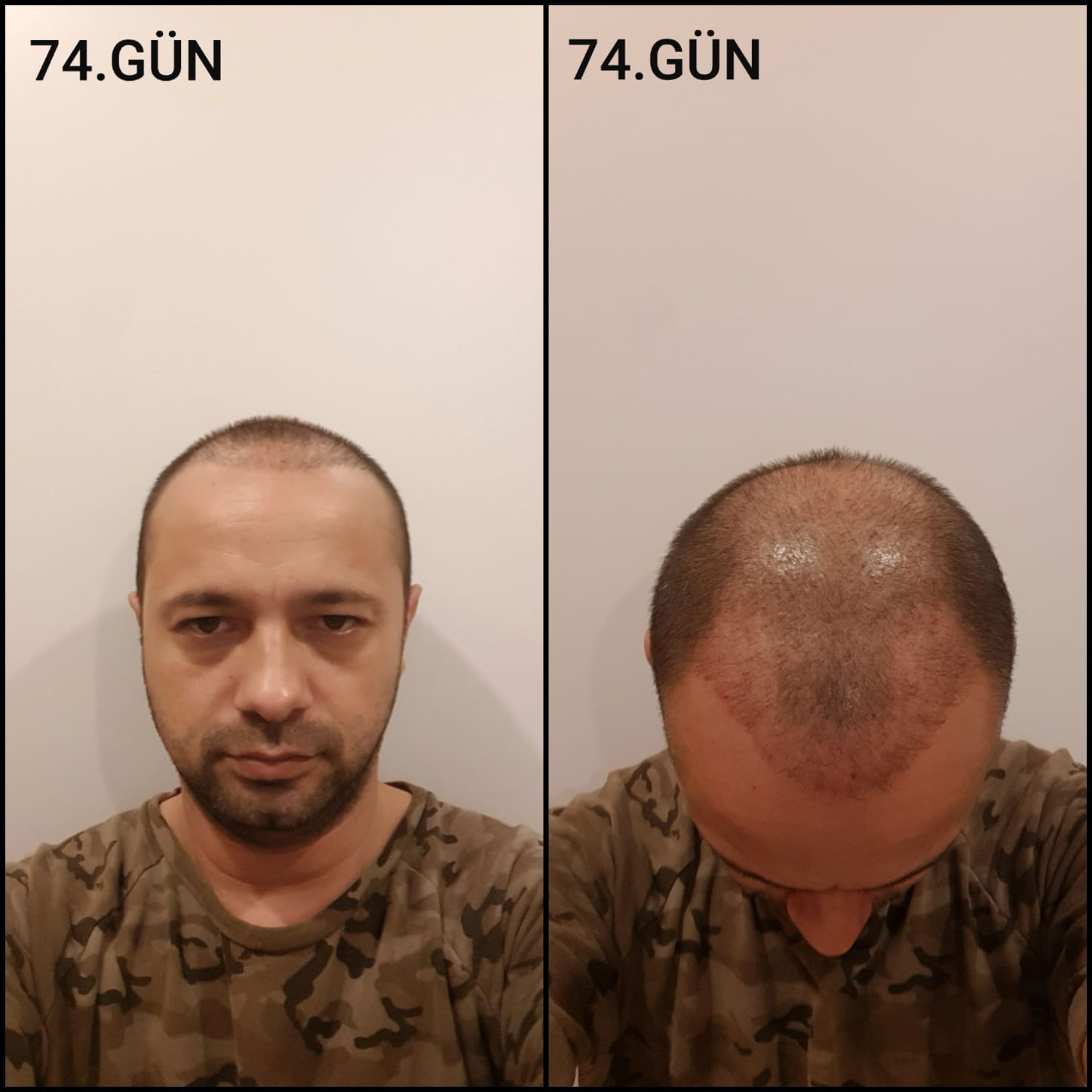 Заживление после пересадки волос день 74 – средняя фаза заживления с шоковым выпадением и дальнейшим процессом заживления