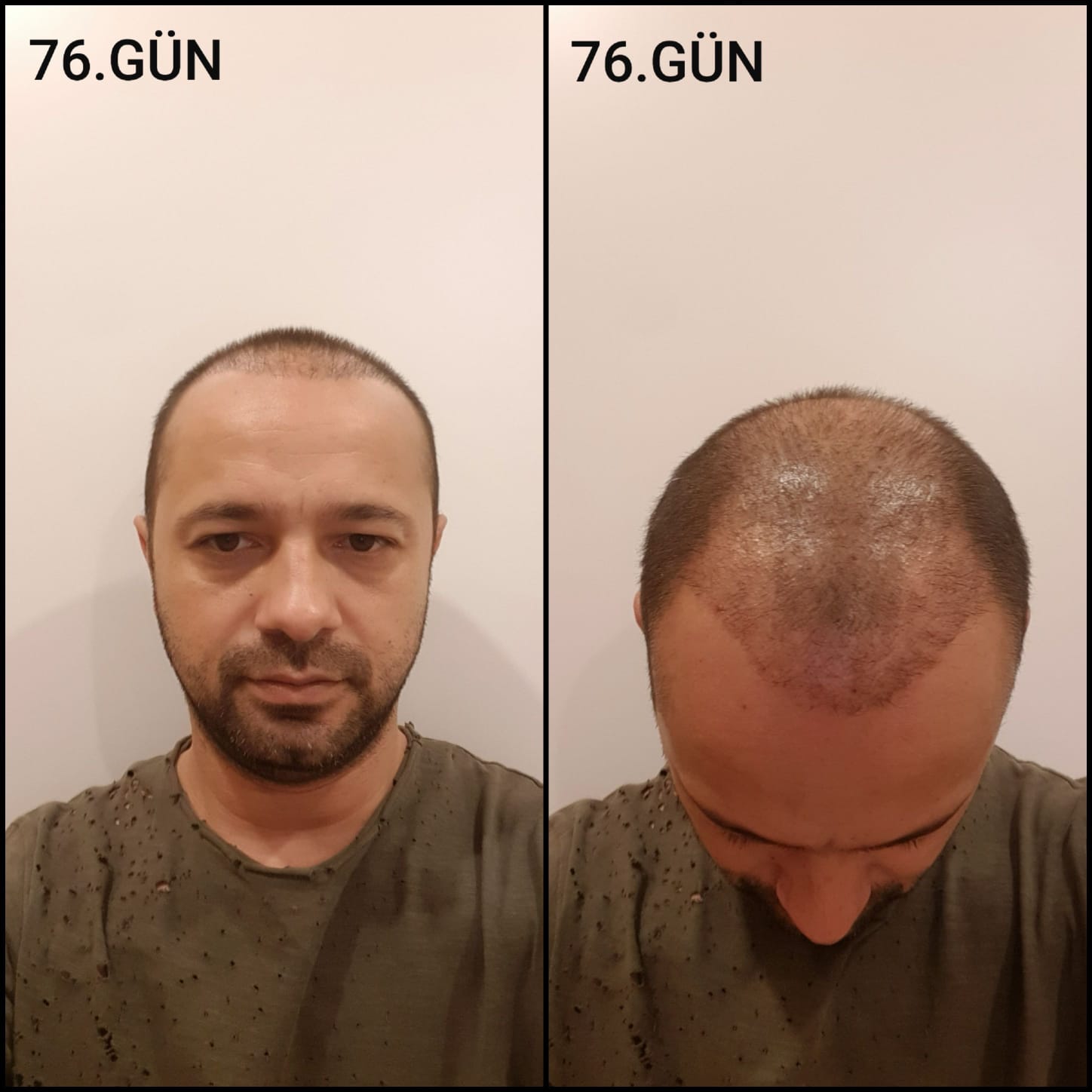 Заживление после пересадки волос день 76 – средняя фаза заживления с шоковым выпадением и дальнейшим процессом заживления