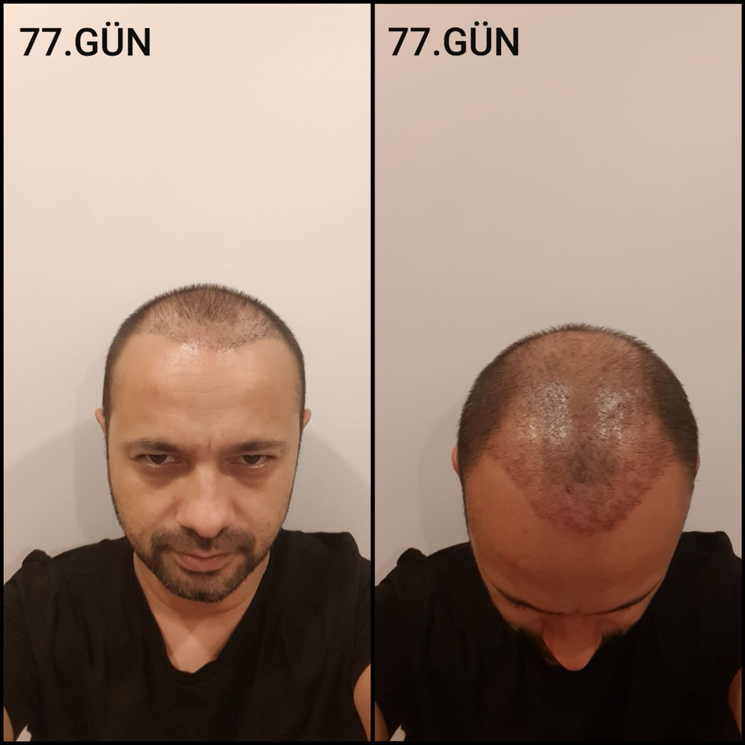 Заживление после пересадки волос день 77 – средняя фаза заживления с шоковым выпадением и дальнейшим процессом заживления