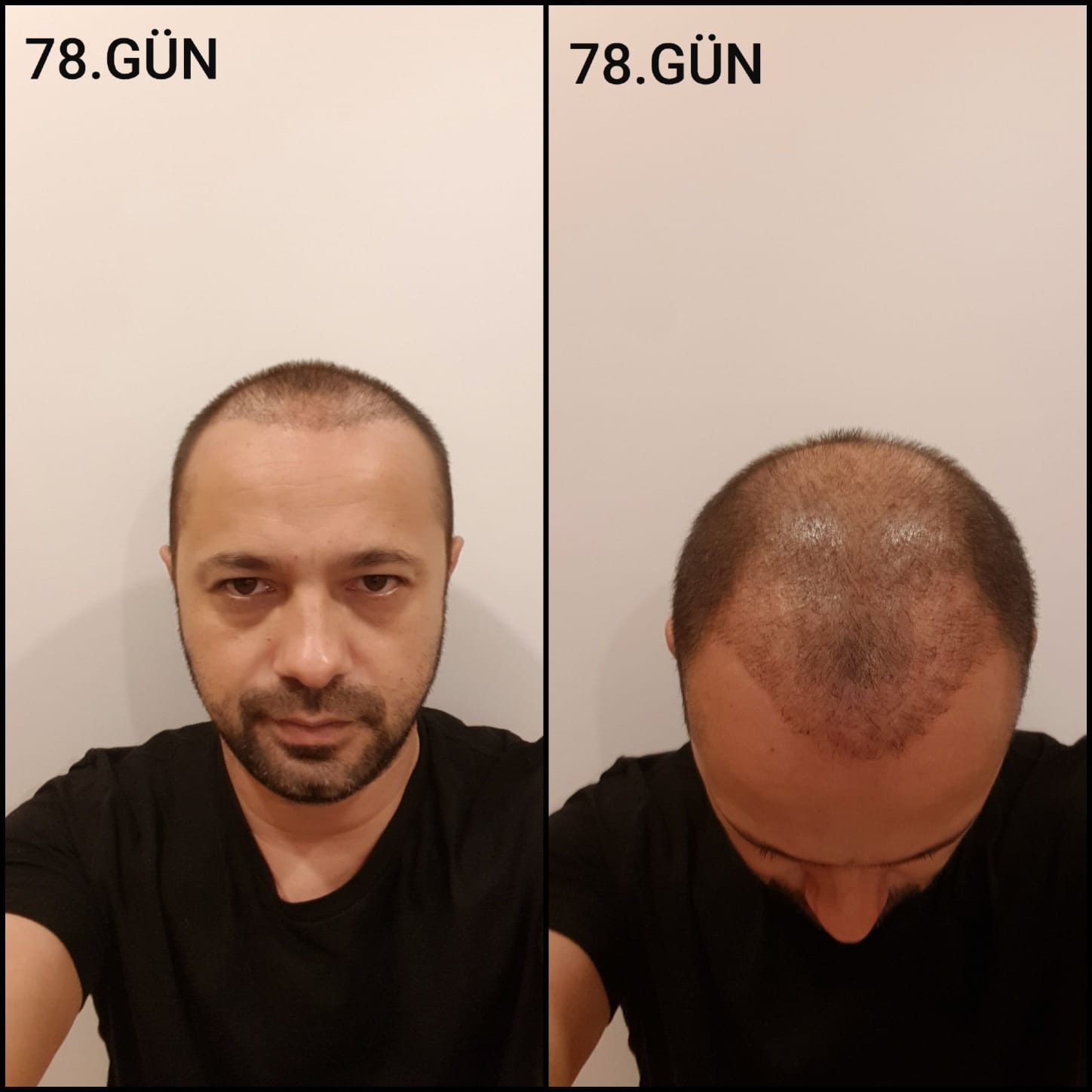 Заживление после пересадки волос день 78 – средняя фаза заживления с шоковым выпадением и дальнейшим процессом заживления