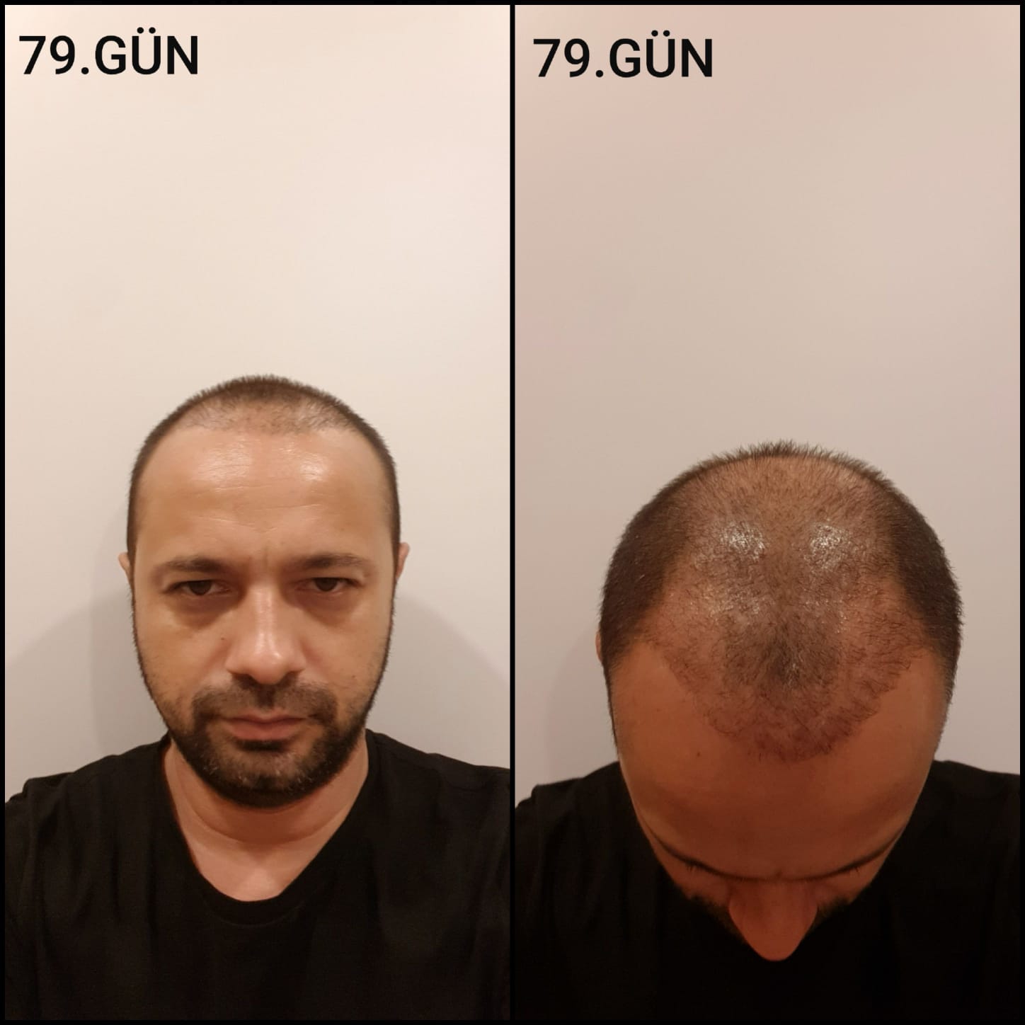 Заживление после пересадки волос день 79 – средняя фаза заживления с шоковым выпадением и дальнейшим процессом заживления