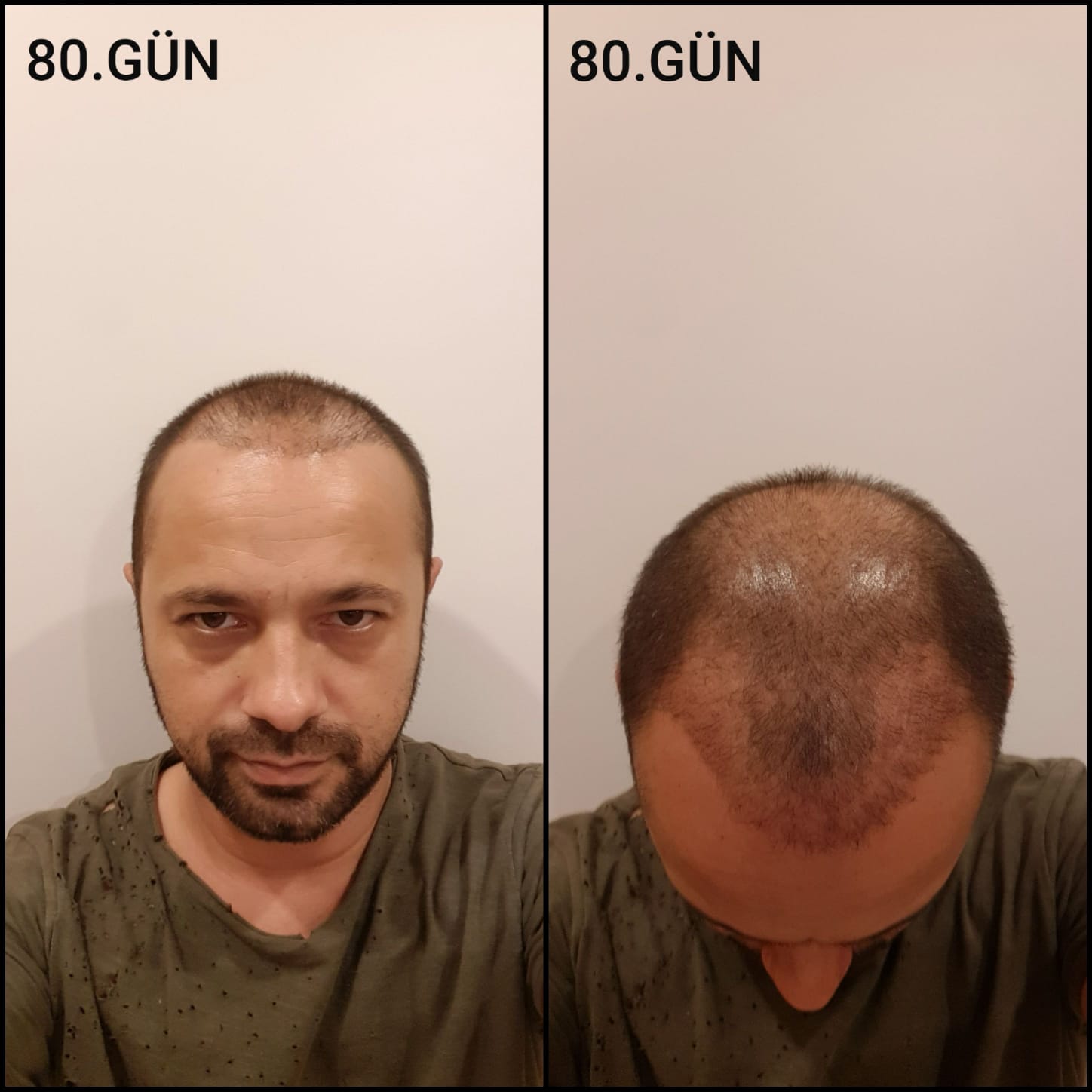 Заживление после пересадки волос день 80 – средняя фаза заживления с шоковым выпадением и дальнейшим процессом заживления
