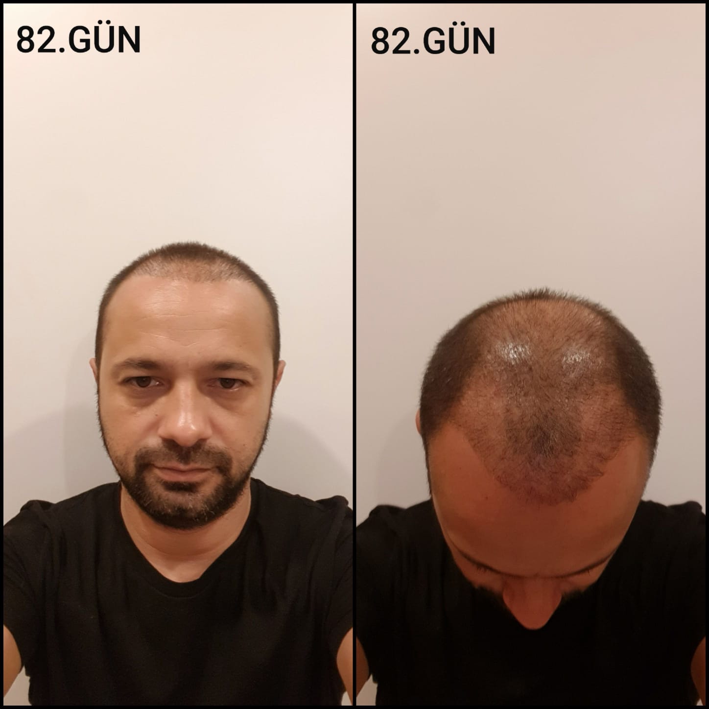 Заживление после пересадки волос день 82 – средняя фаза заживления с шоковым выпадением и дальнейшим процессом заживления