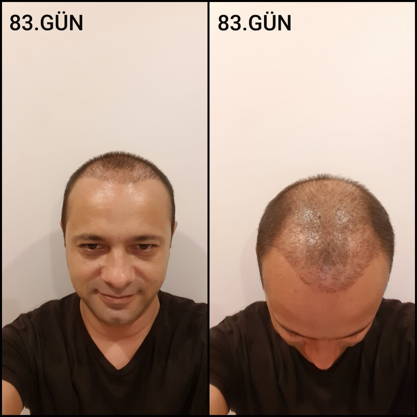 Заживление после пересадки волос день 83 – средняя фаза заживления с шоковым выпадением и дальнейшим процессом заживления
