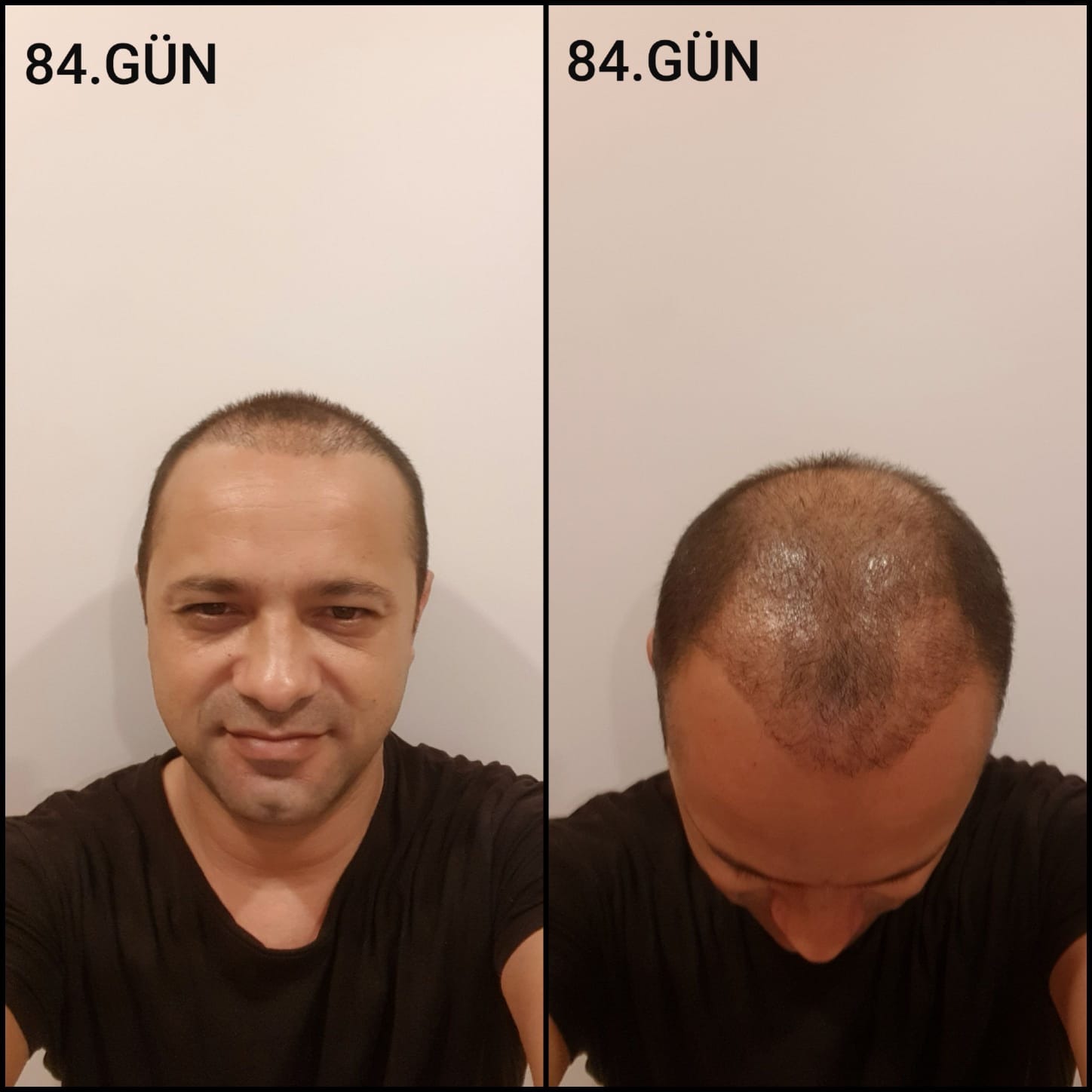 Заживление после пересадки волос день 84 – средняя фаза заживления с шоковым выпадением и дальнейшим процессом заживления
