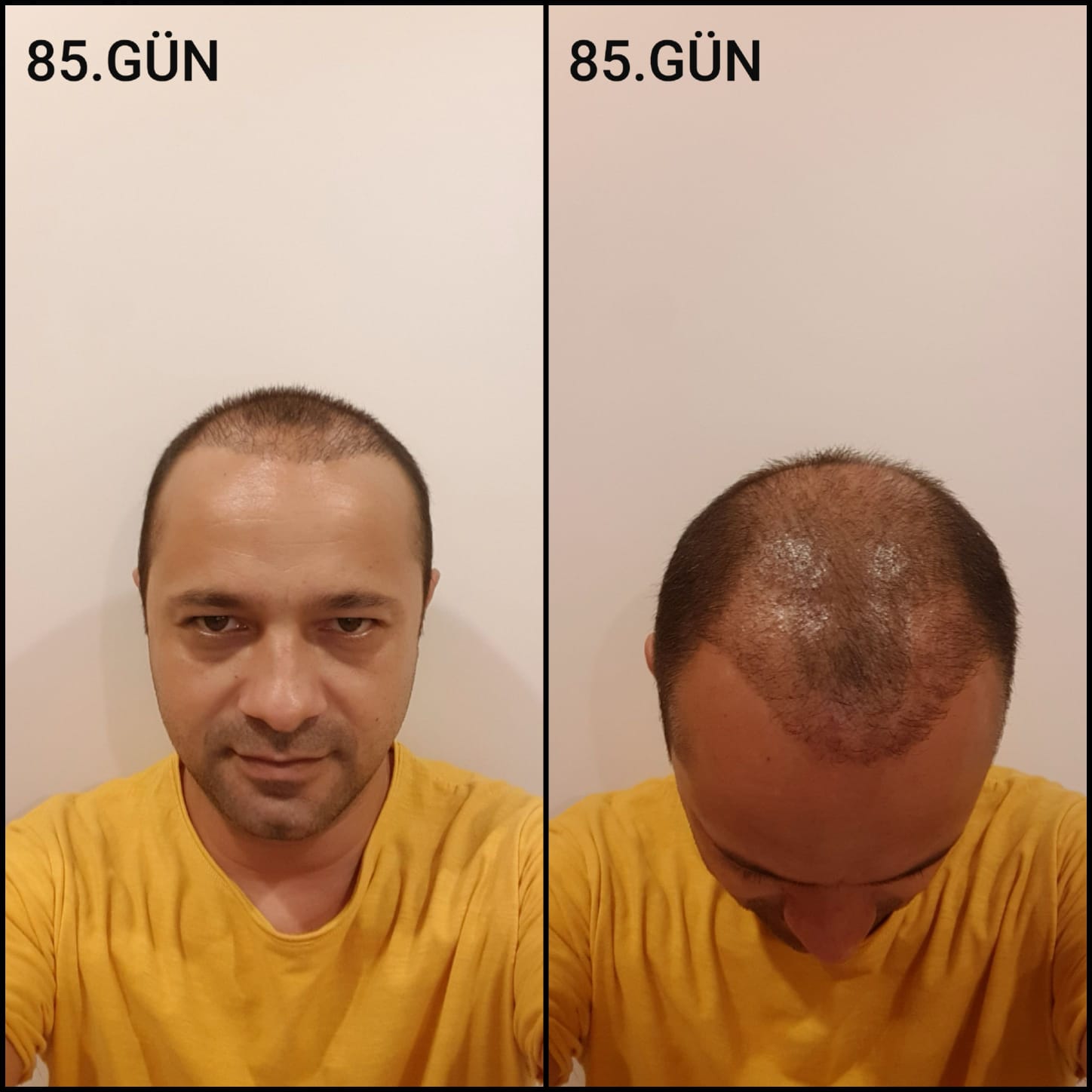 Заживление после пересадки волос день 85 – средняя фаза заживления с шоковым выпадением и дальнейшим процессом заживления