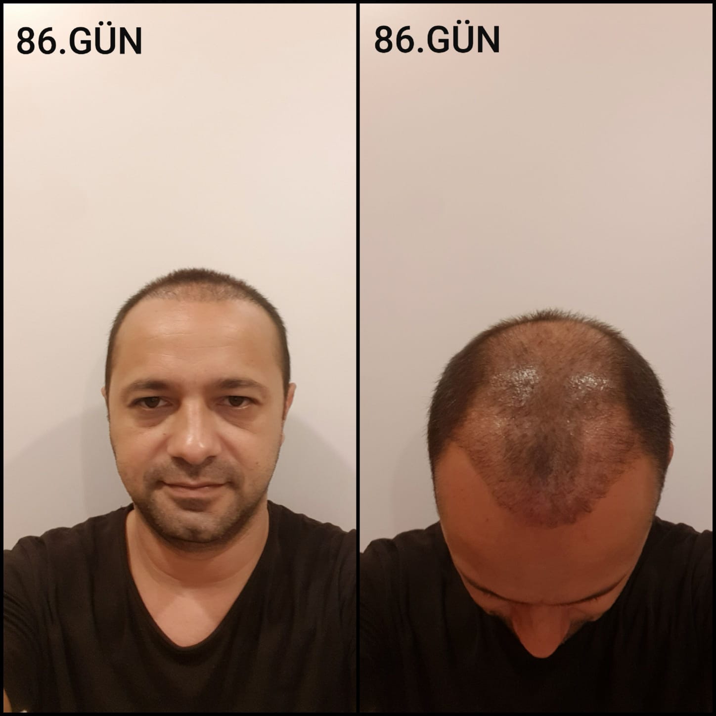 Заживление после пересадки волос день 86 – средняя фаза заживления с шоковым выпадением и дальнейшим процессом заживления