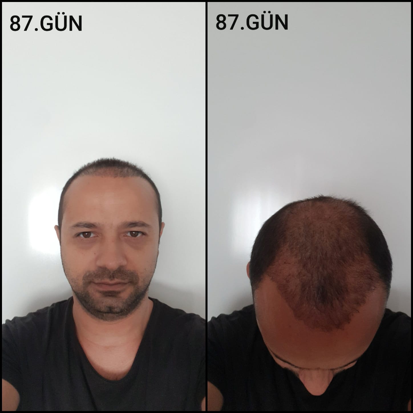 Заживление после пересадки волос день 87 – средняя фаза заживления с шоковым выпадением и дальнейшим процессом заживления