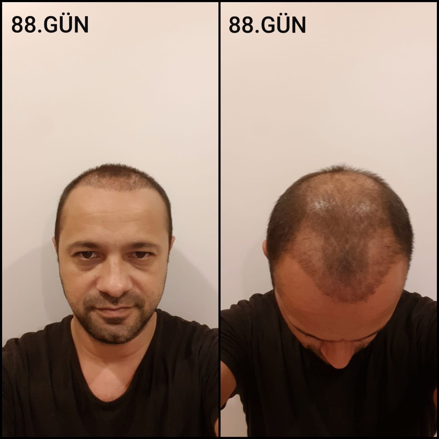 Заживление после пересадки волос день 88 – средняя фаза заживления с шоковым выпадением и дальнейшим процессом заживления