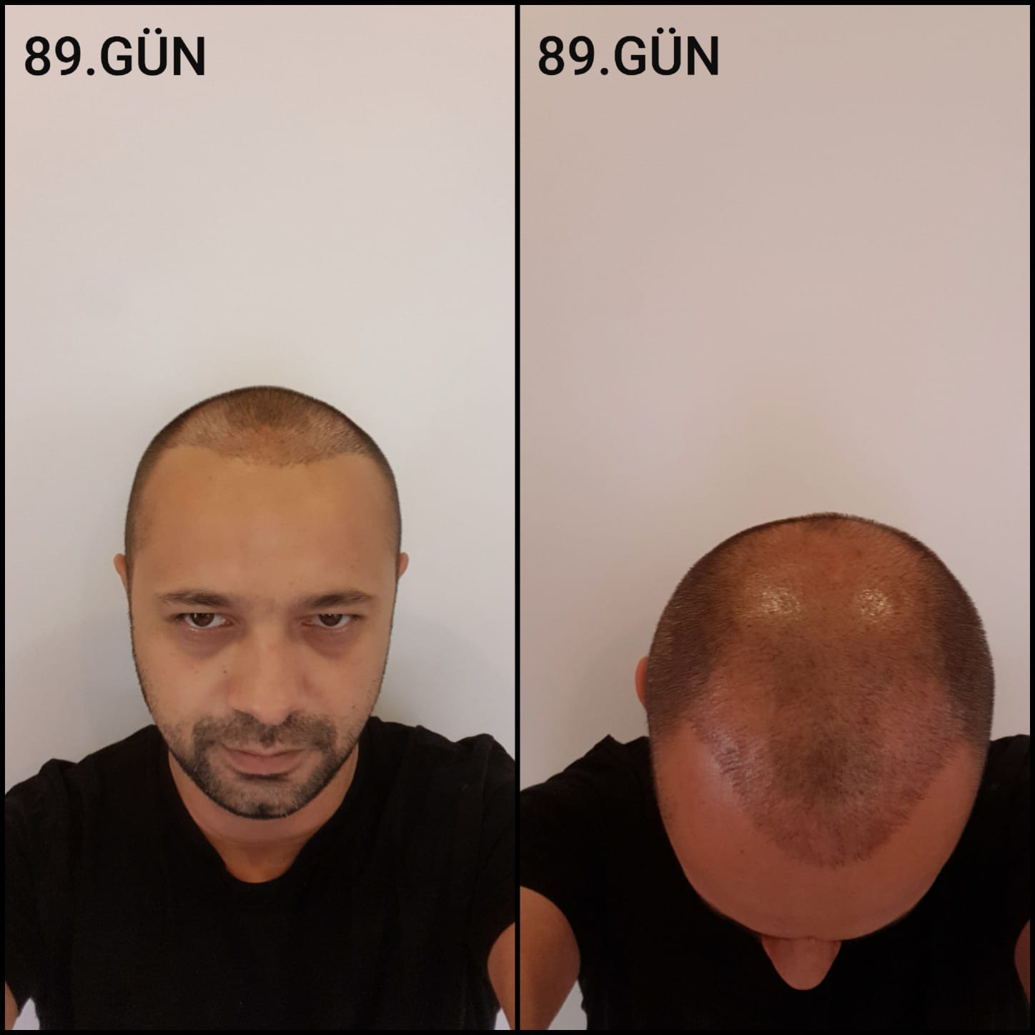 Заживление после пересадки волос день 89 – средняя фаза заживления с шоковым выпадением и дальнейшим процессом заживления