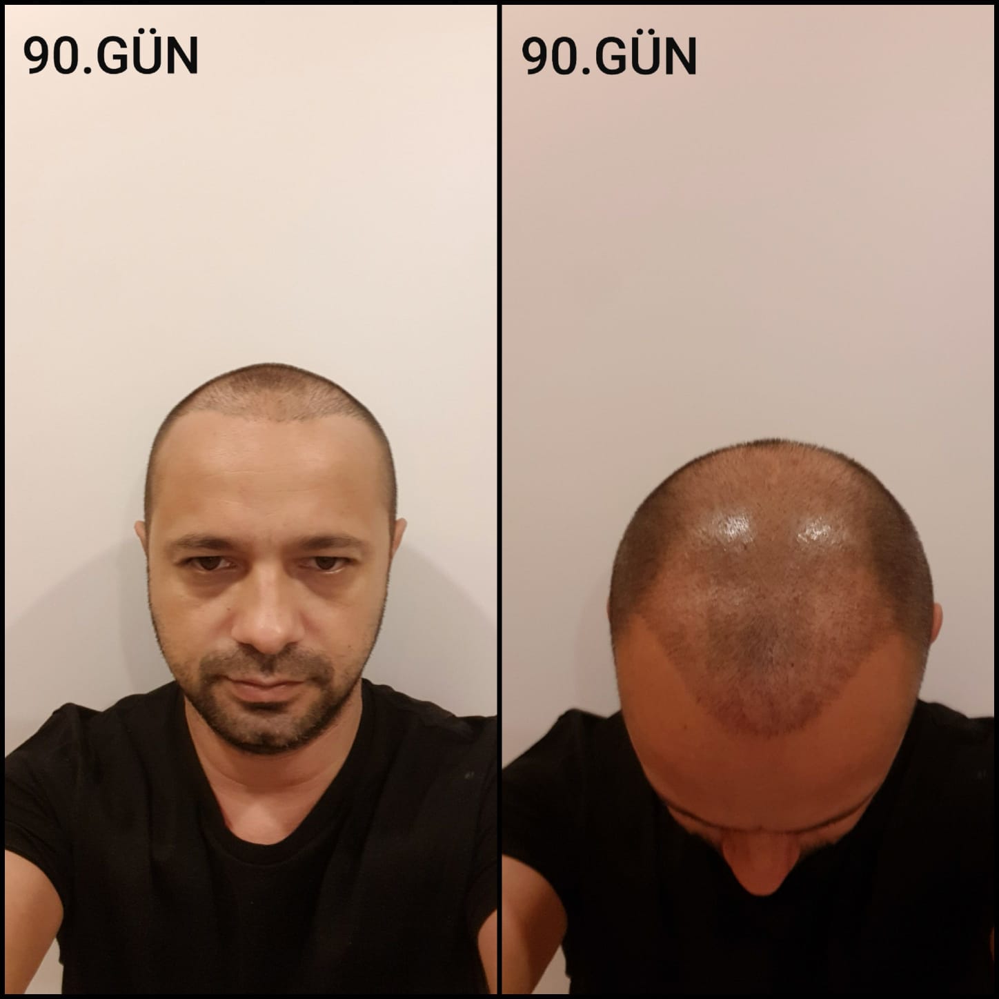 Заживление после пересадки волос день 90 – средняя фаза заживления с шоковым выпадением и дальнейшим процессом заживления