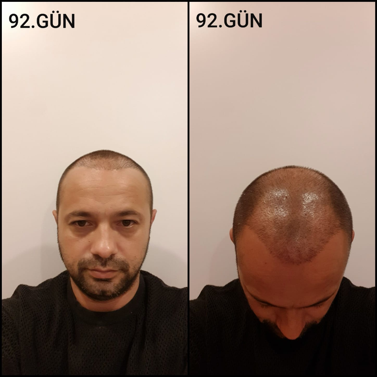 Заживление после пересадки волос день 92 – средняя фаза заживления с шоковым выпадением и дальнейшим процессом заживления