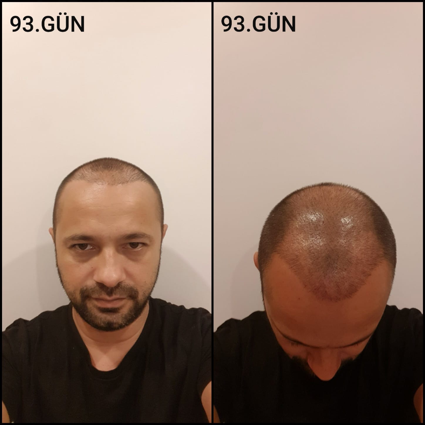 Заживление после пересадки волос день 93 – средняя фаза заживления с шоковым выпадением и дальнейшим процессом заживления