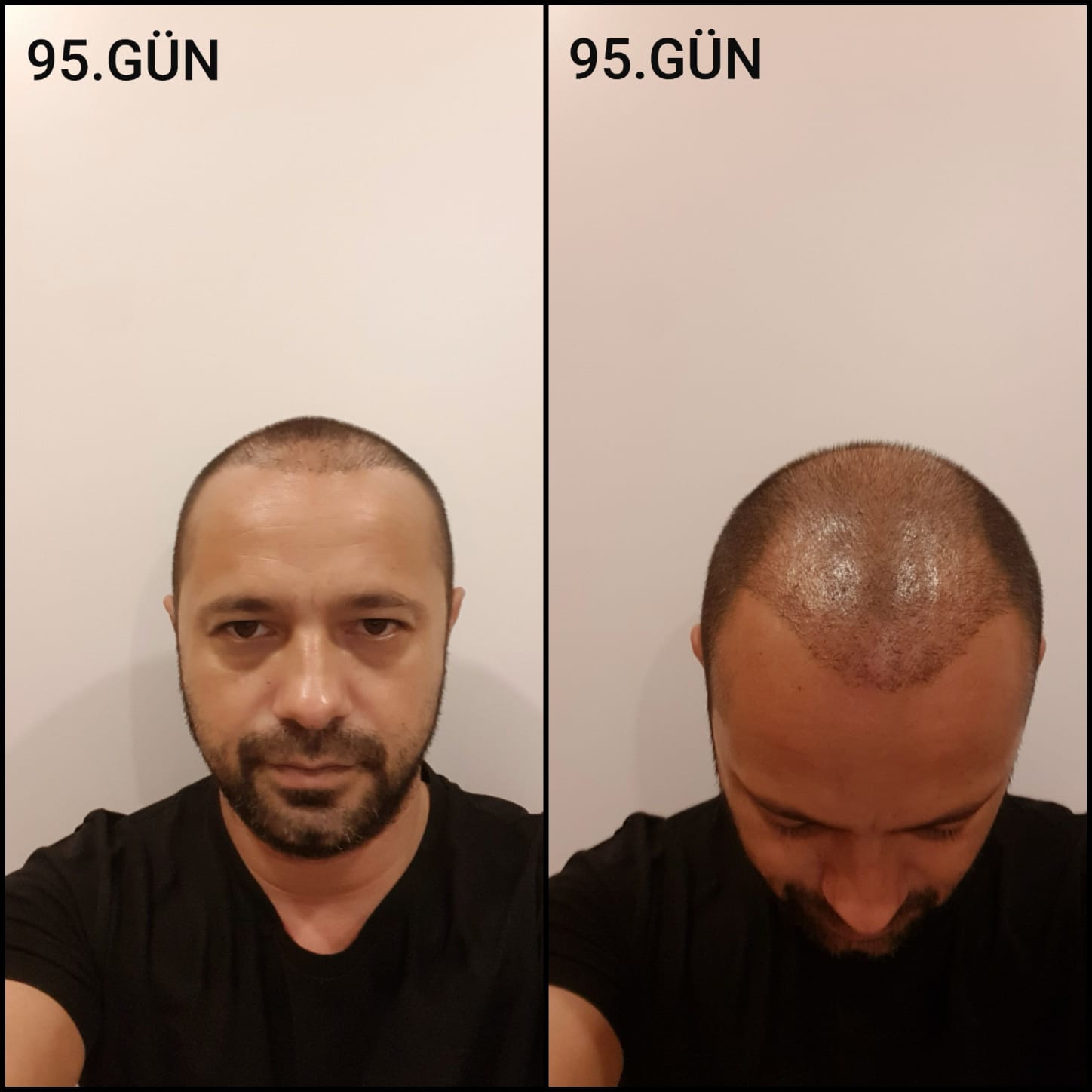Заживление после пересадки волос день 95 – средняя фаза заживления с шоковым выпадением и дальнейшим процессом заживления
