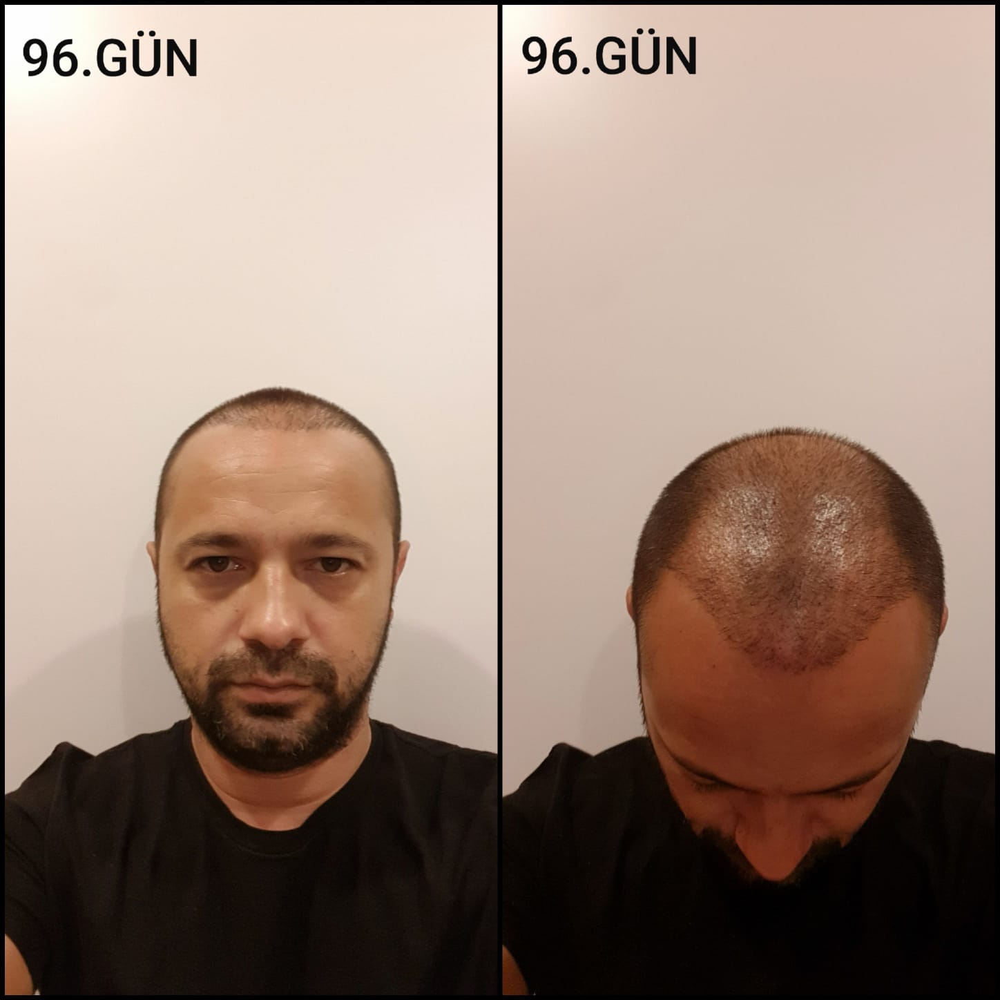Заживление после пересадки волос день 96 – средняя фаза заживления с шоковым выпадением и дальнейшим процессом заживления